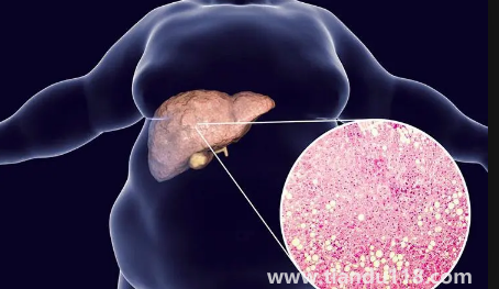 肝代謝不好吃什么調理(肝代謝不好有什么癥狀)(圖3) 肝代謝不好吃什么調理3