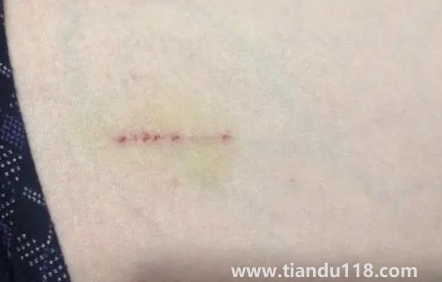 被貓抓了一下輕微破皮要打針嗎（被貓抓傷多少天過(guò)危險(xiǎn)期）