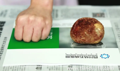 腎結石3mm需要吃藥嗎（3mm的腎結石會尿血嗎）