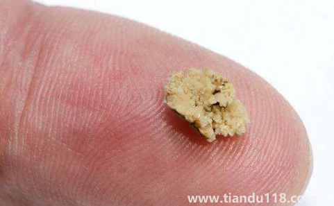 腎結(jié)石三毫米可以碎嗎(三毫米的腎結(jié)石算大的嗎)(圖2) 腎結(jié)石三毫米可以碎嗎2
