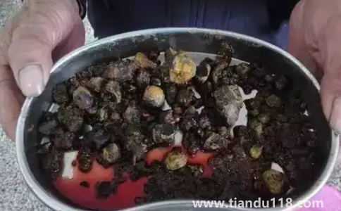 腎結(jié)石3mm×3mm多大(雙腎3×3mm小結(jié)石怎么辦)(圖3) 腎結(jié)石3mm×3mm多大3